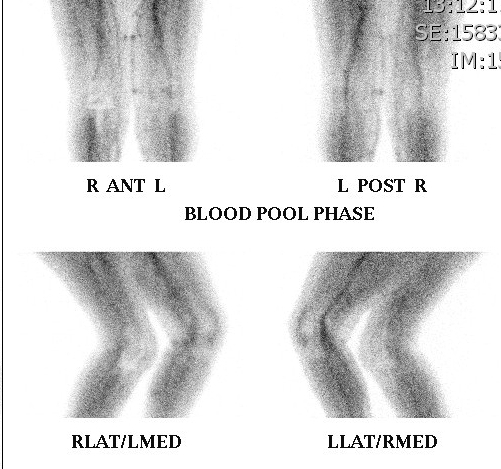 Bone Scan Blood Pool Phase
